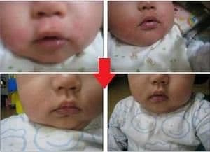 子供のアトピー